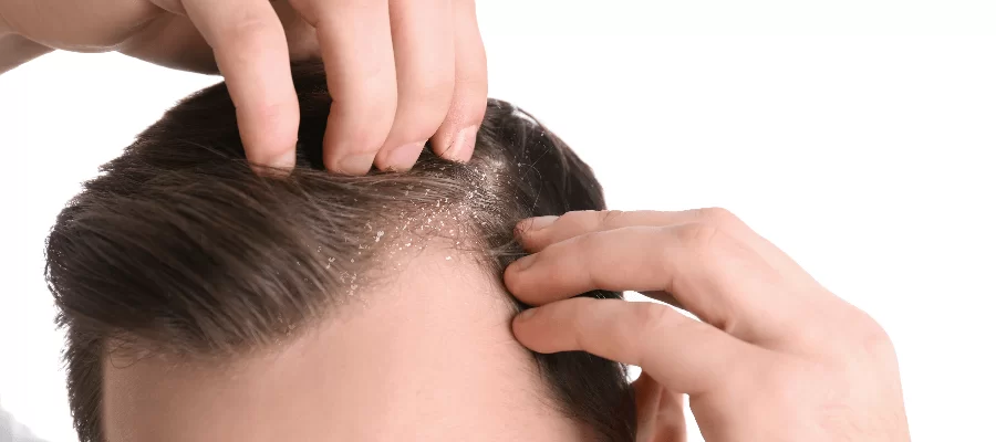 3 dicas práticas e eficazes de como controlar a caspa do cabelo masculino | Blog Mantecorp Skincare